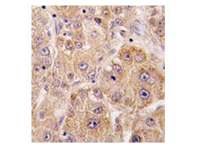 IHC testing of FFPE human hepatocarcinoma tissue with UVRAG antibody. HIER: steam section in pH6 citrate buffer for 20 min and allow to cool prior to staining.