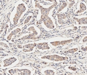 IHC testing of FFPE human breast cancer tissue with MAP2K1 antibody. HIER: steam section in pH9 EDTA for 20 min and allow to cool prior to staining.