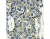 IHC testing of FFPE human breast cancer tissue with EIF4B antibody. HIER: steam section in pH6 citrate buffer for 20 min and allow to cool prior to staining.