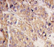 IHC testing of FFPE human breast carcinoma tissue with SMURF1 antibody. HIER: steam section in pH6 citrate buffer for 20 min and allow to cool prior to staining.