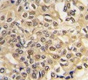 IHC testing of FFPE human hepatocellular carcinoma tissue with Ubiquitin-like modifier-activating enzyme 1 antibody. HIER: steam section in pH6 citrate buffer for 20 min and allow to cool prior to staining.