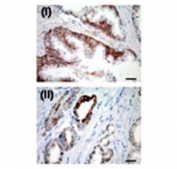 IHC staining of FFPE human prostate with USP2 antibody. Cytoplasmic positive immunostaining was detected in tumor glands (ii), whereas in normal prostatic epithelium USP2a expression was restricted to the basal layer (i).