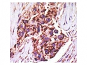 IHC testing of FFPE human breast cancer tissue with USP13 antibody. HIER: steam section in pH6 citrate buffer for 20 min and allow to cool prior to staining.