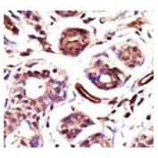 IHC testing of FFPE human breast cancer tissue with Ubiquitin-protein ligase E3A antibody. HIER: steam section in pH6 citrate buffer for 20 min and allow to cool prior to staining.