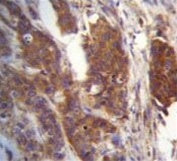 IHC testing of FFPE human bladder carcinoma tissue with Ufm1-conjugating enzyme 1 antibody. HIER: steam section in pH6 citrate buffer for 20 min and allow to cool prior to staining.