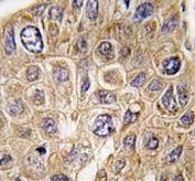 IHC testing of FFPE human hepatocellular carcinoma tissue with Squalene synthase antibody. HIER: steam section in pH6 citrate buffer for 20 min and allow to cool prior to staining.