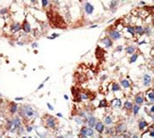 IHC testing of FFPE human cancer tissue with NUB1 antibody. HIER: steam section in pH6 citrate buffer for 20 min and allow to cool prior to staining.