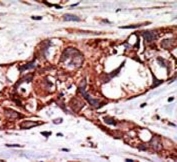 IHC testing of FFPE human breast cancer tissue with SUMO-activating enzyme subunit 1 antibody. HIER: steam section in pH6 citrate buffer for 20 min and allow to cool prior to staining.