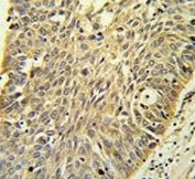 IHC testing of FFPE human lung carcinoma tissue with MTHFD1 antibody. HIER: steam section in pH6 citrate buffer for 20 min and allow to cool prior to staining.