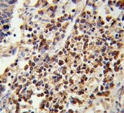 IHC testing of FFPE human lung carcinoma tissue with U2AF1 antibody. HIER: steam section in pH6 citrate buffer for 20 min and allow to cool prior to staining.