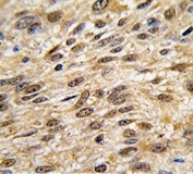 IHC testing of FFPE human lung carcinoma tissue with SHP-1 antibody. HIER: steam section in pH6 citrate buffer for 20 min and allow to cool prior to staining.