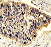 IHC testing of FFPE human lung carcinoma tissue with PA2G4 antibody. HIER: steam section in pH6 citrate buffer for 20 min and allow to cool prior to staining.