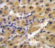 IHC testing of FFPE human hepatocellular carcinoma tissue with ENPP2 antibody. HIER: steam section in pH6 citrate buffer for 20 min and allow to cool prior to staining.