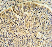 IHC testing of FFPE human lung carcinoma tissue with TCP1 gamma antibody. HIER: steam section in pH6 citrate buffer for 20 min and allow to cool prior to staining.