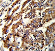 IHC testing of FFPE human hepatocellular carcinoma tissue with Endoplasmic reticulum resident protein 29 antibody. HIER: steam section in pH6 citrate buffer for 20 min and allow to cool prior to staining.