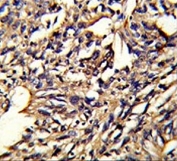 IHC testing of FFPE human lung carcinoma tissue with PSMD13 antibody. HIER: steam section in pH6 citrate buffer for 20 min and allow to cool prior to staining.