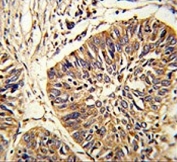 IHC testing of FFPE human lung carcinoma tissue with Protein disulfide-isomerase A3 antibody. HIER: steam section in pH6 citrate buffer for 20 min and allow to cool prior to staining.