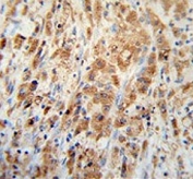 IHC testing of FFPE human colon carcinoma tissue with Peroxiredoxin 1 antibody. HIER: steam section in pH6 citrate buffer for 20 min and allow to cool prior to staining.