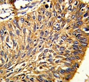 IHC testing of FFPE human lung carcinoma tissue with PRDX3 antibody. HIER: steam section in pH6 citrate buffer for 20 min and allow to cool prior to staining.