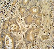 IHC testing of FFPE human colon carcinoma tissue with IMMT antibody. HIER: steam section in pH6 citrate buffer for 20 min and allow to cool prior to staining.