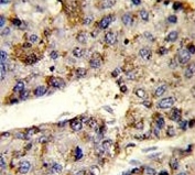 IHC testing of FFPE human hepatocellular carcinoma tissue with HNRPL antibody. HIER: steam section in pH6 citrate buffer for 20 min and allow to cool prior to staining.