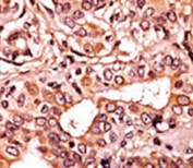 IHC testing of FFPE human breast tissue with phospho-CDK7 antibody. HIER: steam section in pH6 citrate buffer for 20 min and allow to cool prior to staining.