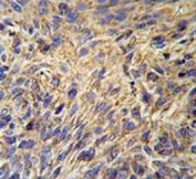 IHC testing of FFPE human lung carcinoma tissue with HSP90B1 antibody. HIER: steam section in pH6 citrate buffer for 20 min and allow to cool prior to staining.