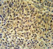 IHC testing of FFPE human bladder carcinoma tissue with IRF7 antibody. HIER: steam section in pH6 citrate buffer for 20 min and allow to cool prior to staining.