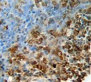 IHC testing of FFPE human lung carcinoma tissue with Inosine triphosphate pyrophosphatase antibody. HIER: steam section in pH6 citrate buffer for 20 min and allow to cool prior to staining.