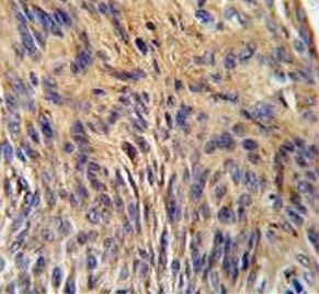 IHC testing of FFPE human lung carcinoma tissue with HSPA5 antibody. HIER: steam section in pH6 citrate buffer for 20 min and allow to cool prior to staining.