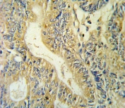 IHC testing of FFPE human colon carcinoma tissue with Peptide YY antibody. HIER: steam section in pH6 citrate buffer for 20 min and allow to cool prior to staining.