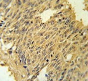 IHC testing of FFPE human lung carcinoma tissue with Mitoferrin-2 antibody. HIER: steam section in pH6 citrate buffer for 20 min and allow to cool prior to staining.