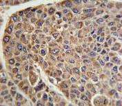IHC testing of FFPE human hepatocellular carcinoma tissue with Pyruvate Dehydrogenase E2 antibody. HIER: steam section in pH6 citrate buffer for 20 min and allow to cool prior to staining.