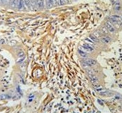 IHC testing of FFPE human colon carcinoma tissue with PRB2 antibody. HIER: steam section in pH6 citrate buffer for 20 min and allow to cool prior to staining.