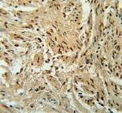 IHC testing of FFPE human cervical carcinoma tissue with BLOC1S2 antibody. HIER: steam section in pH6 citrate buffer for 20 min and allow to cool prior to staining.