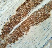 IHC testing of FFPE human prostate carcinoma tissue with STEA2 antibody. HIER: steam section in pH6 citrate buffer for 20 min and allow to cool prior to staining.
