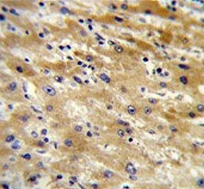 IHC testing of FFPE human hepatocellular carcinoma tissue with HABP2 antibody. HIER: steam section in pH6 citrate buffer for 20 min and allow to cool prior to staining.