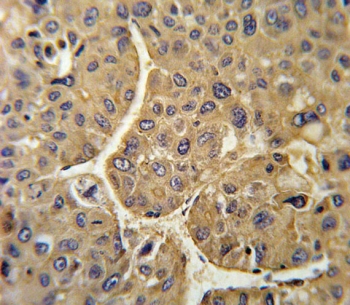 IHC testing of FFPE human hepatocellular carcinoma tissue with FHR-5 antibody. HIER: steam section in pH6 citrate buffer for 20 min and allow to cool prior to staining.