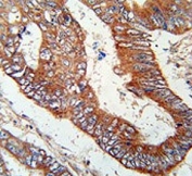 IHC testing of FFPE human colon carcinoma tissue with Kelch-like protein 6 antibody. HIER: steam section in pH6 citrate buffer for 20 min and allow to cool prior to staining.