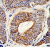 IHC testing of FFPE human prostate carcinoma tissue with DNAJA1 antibody. HIER: steam section in pH6 citrate buffer for 20 min and allow to cool prior to staining.