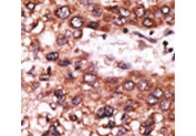 IHC testing of FFPE human cancer tissue with Beta-secretase 1 antibody. HIER: steam section in pH6 citrate buffer for 20 min and allow to cool prior to staining.