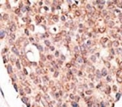IHC testing of FFPE human cancer tissue with Cryptochrome 2 antibody. HIER: steam section in pH6 citrate buffer for 20 min and allow to cool prior to staining.