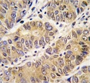 IHC testing of FFPE human hepatocellular carcinoma tissue with Collagenase 3 antibody. HIER: steam section in pH6 citrate buffer for 20 min and allow to cool prior to staining.