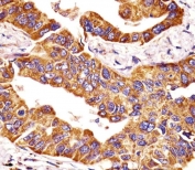 IHC testing of FFPE human lung adenocarcinoma tissue with MMP14 antibody. HIER: steam section in pH6 citrate buffer for 20 min and allow to cool prior to staining.