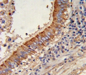 IHC testing of FFPE human lung carcinoma tissue with Major Vault Protein antibody. HIER: steam section in pH6 citrate buffer for 20 min and allow to cool prior to staining.