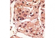 IHC testing of FFPE human cancer tissue with Presenilin 1 antibody. HIER: steam section in pH6 citrate buffer for 20 min and allow to cool prior to staining.