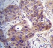 IHC testing of FFPE human breast carcinoma tissue with KLK6 antibody. HIER: steam section in pH6 citrate buffer for 20 min and allow to cool prior to staining.