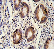 IHC testing of FFPE human colon carcinoma tissue with CLNS1A antibody. HIER: steam section in pH6 citrate buffer for 20 min and allow to cool prior to staining.