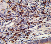 IHC testing of FFPE human colon carcinoma tissue with CNOT8 antibody. HIER: steam section in pH6 citrate buffer for 20 min and allow to cool prior to staining.