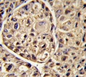 IHC testing of FFPE human hepatocellular carcinoma tissue with ELOVL6 antibody. HIER: steam section in pH6 citrate buffer for 20 min and allow to cool prior to staining.